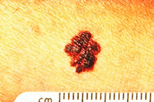 An example of melanoma